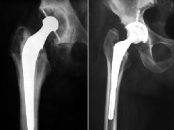 Le colocaron una prtesis articular de cadera, rodilla. Bogot D.C., Colombia