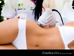 CAVITACION - LIPOESCULTURA SIN CIRUG�A BOGOTA, COLOMBIA