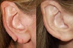 correccion del lobulo de las orejas rasgadas medellin, colombia