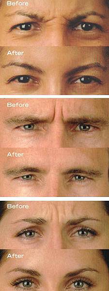 BOTOX 2 POR EL PRECIO DE UNO PROFORMA MEDICAL SPA Bogota, Colombia